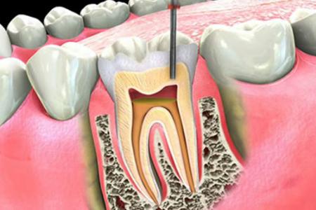 得了牙髓炎要怎麽治療？