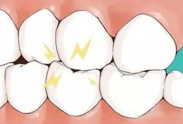 深圳牙科-夜磨牙到底是怎麼一回事呢？