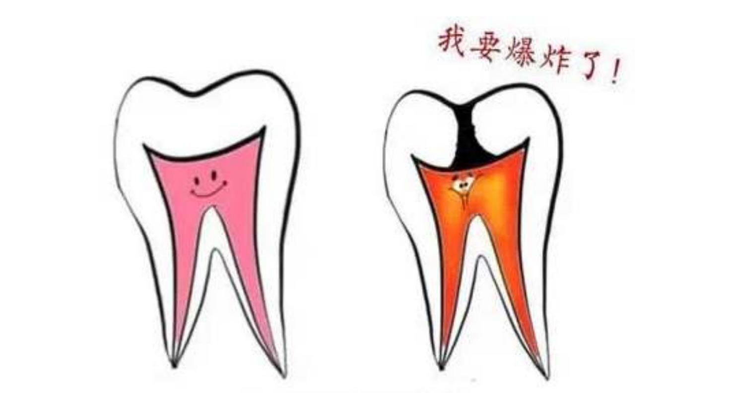 得了根尖周炎應該怎麽治療？