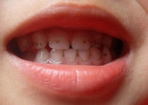 影響孩子牙齒健康的九大“惡習”
