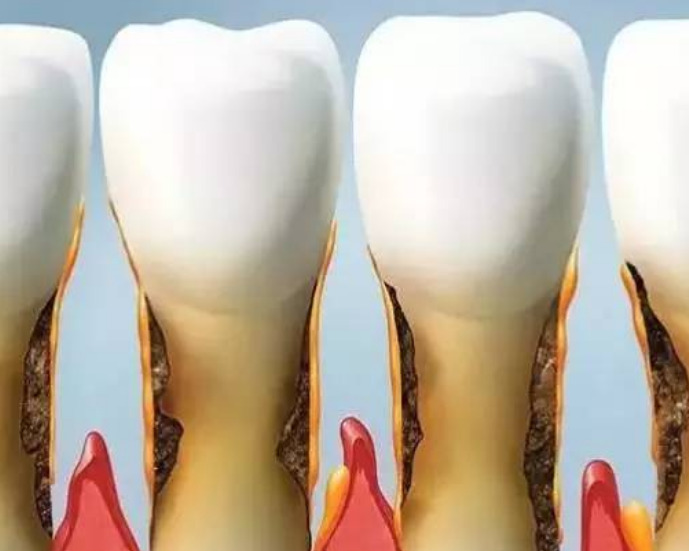 深圳牙科——老年人口腔保健要注意什麼呢？