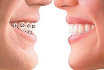 牙齒矯正你瞭解多少？箍牙的目的是什麽？