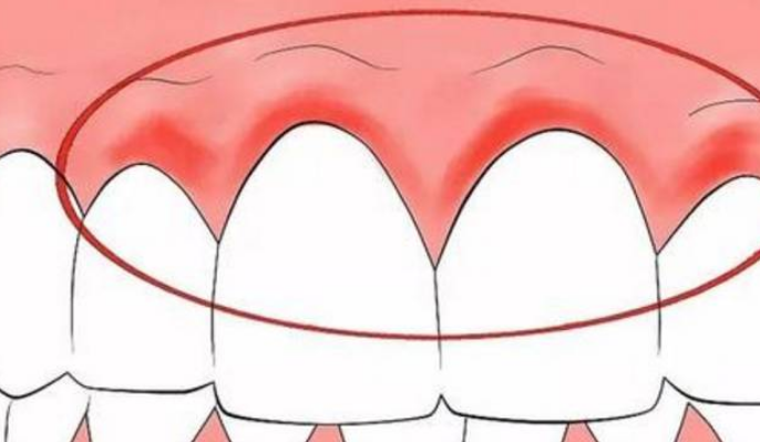 深圳牙周治療——牙齦炎會有哪些表現呢？