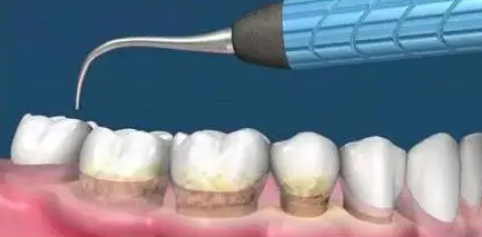深圳牙周治療