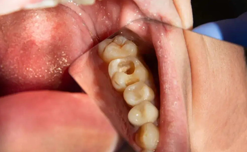 蛀牙嘅窿被醫生磨大咗點算？深圳補牙有冇好牙科推介？