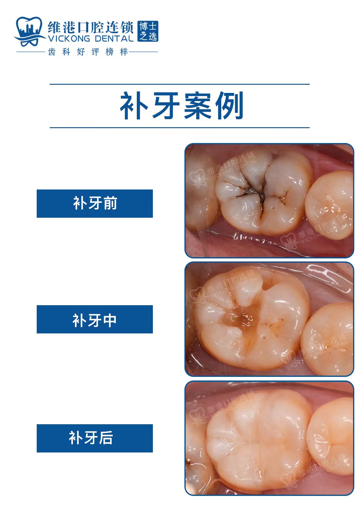 深圳補牙