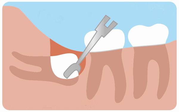 深圳拔智齒