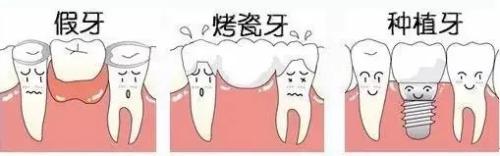 深圳種植牙