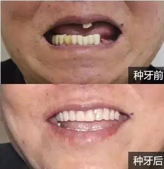 深圳種植牙