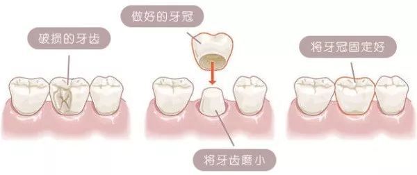 深圳牙冠推介