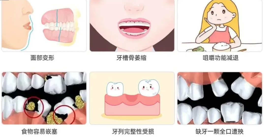 深圳種植牙