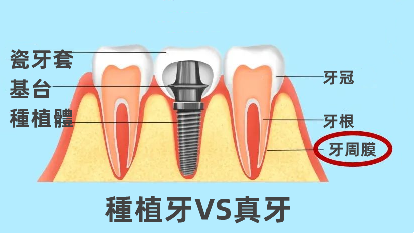深圳種植牙