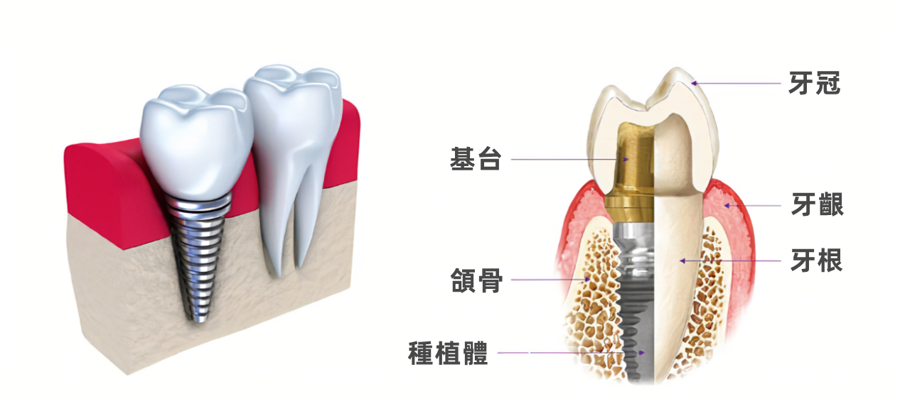 深圳種植牙