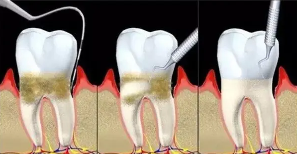 深圳牙周治療