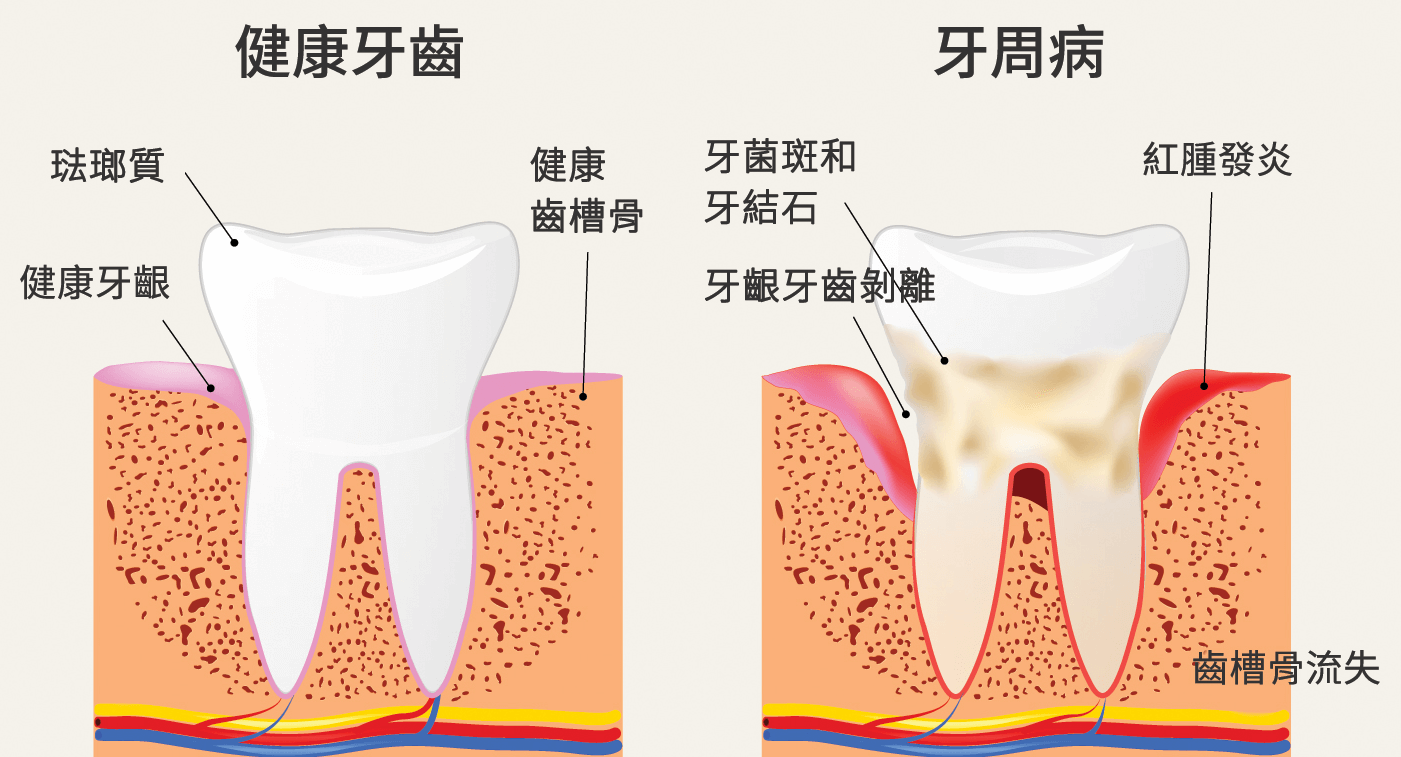 深圳牙周治療