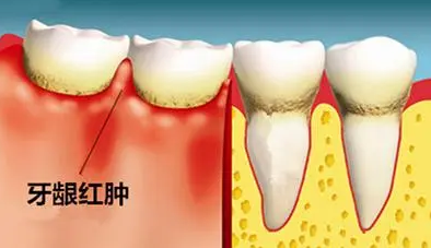 深圳牙周炎治療