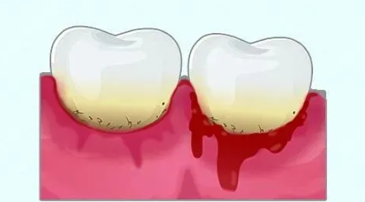 牙周炎早期會有咩表現咧？深圳牙周治療收費標準2024