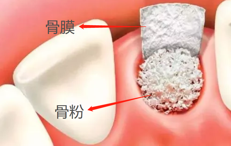 深圳植牙植骨粉