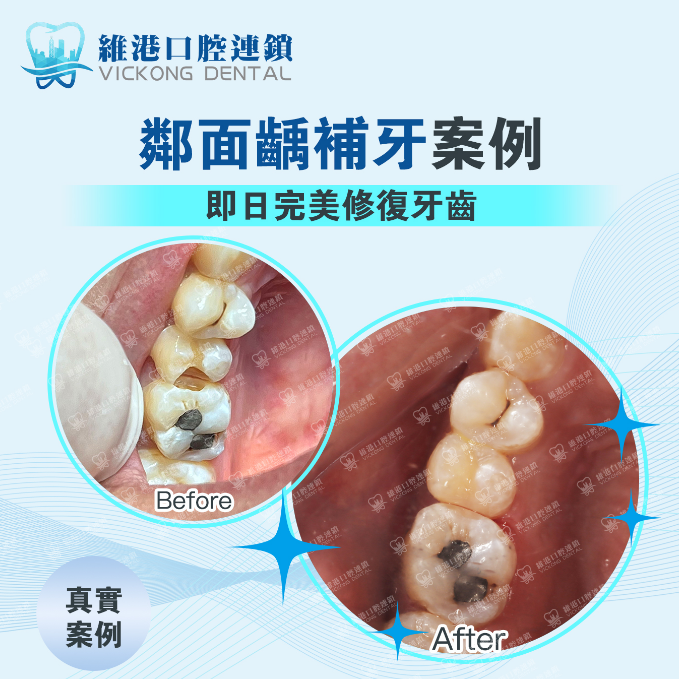 深圳補牙