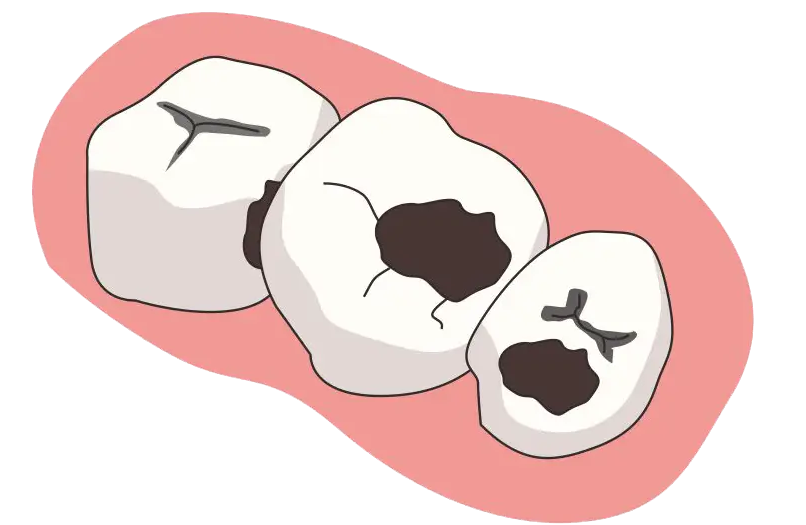 深圳補牙價錢