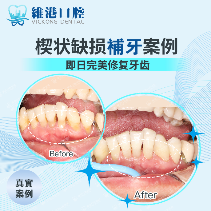深圳補牙幾錢