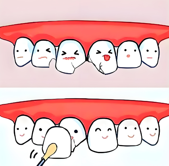 深圳牙貼面