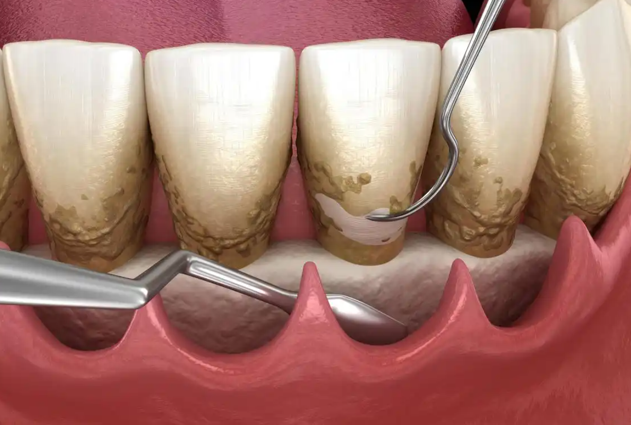 深圳牙周治療 深圳牙周治療