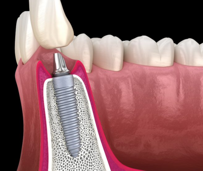北上植牙 北上植牙