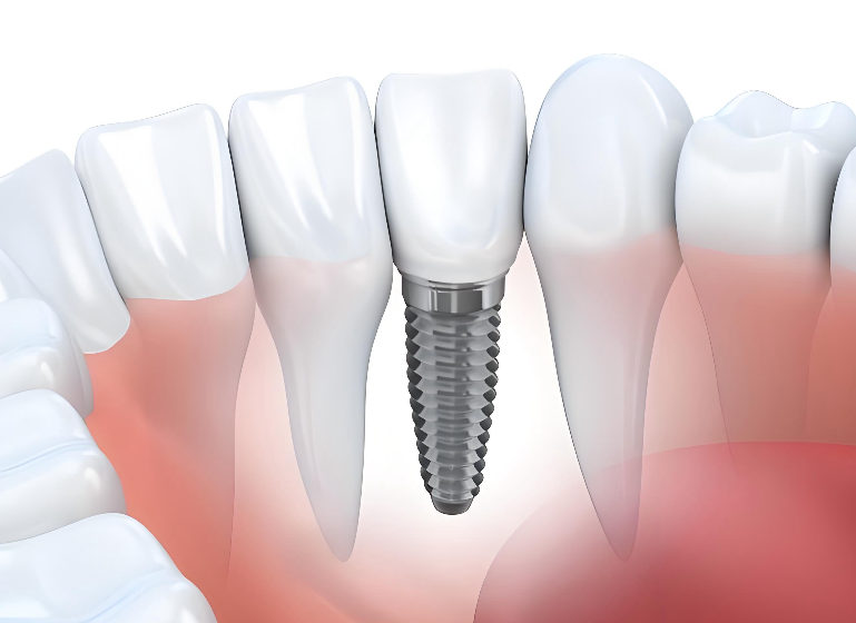 深圳種牙邊度好