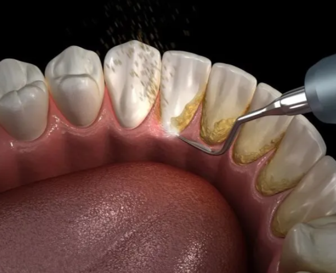 維港口腔牙醫洗牙