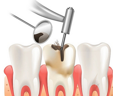 深圳杜牙根收费 深圳杜牙根收费