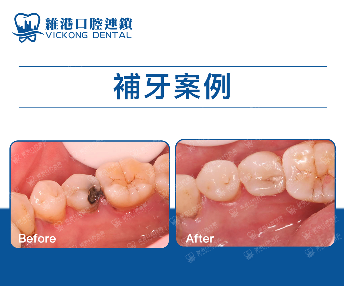 深圳羅湖補牙案例 深圳羅湖補牙案例