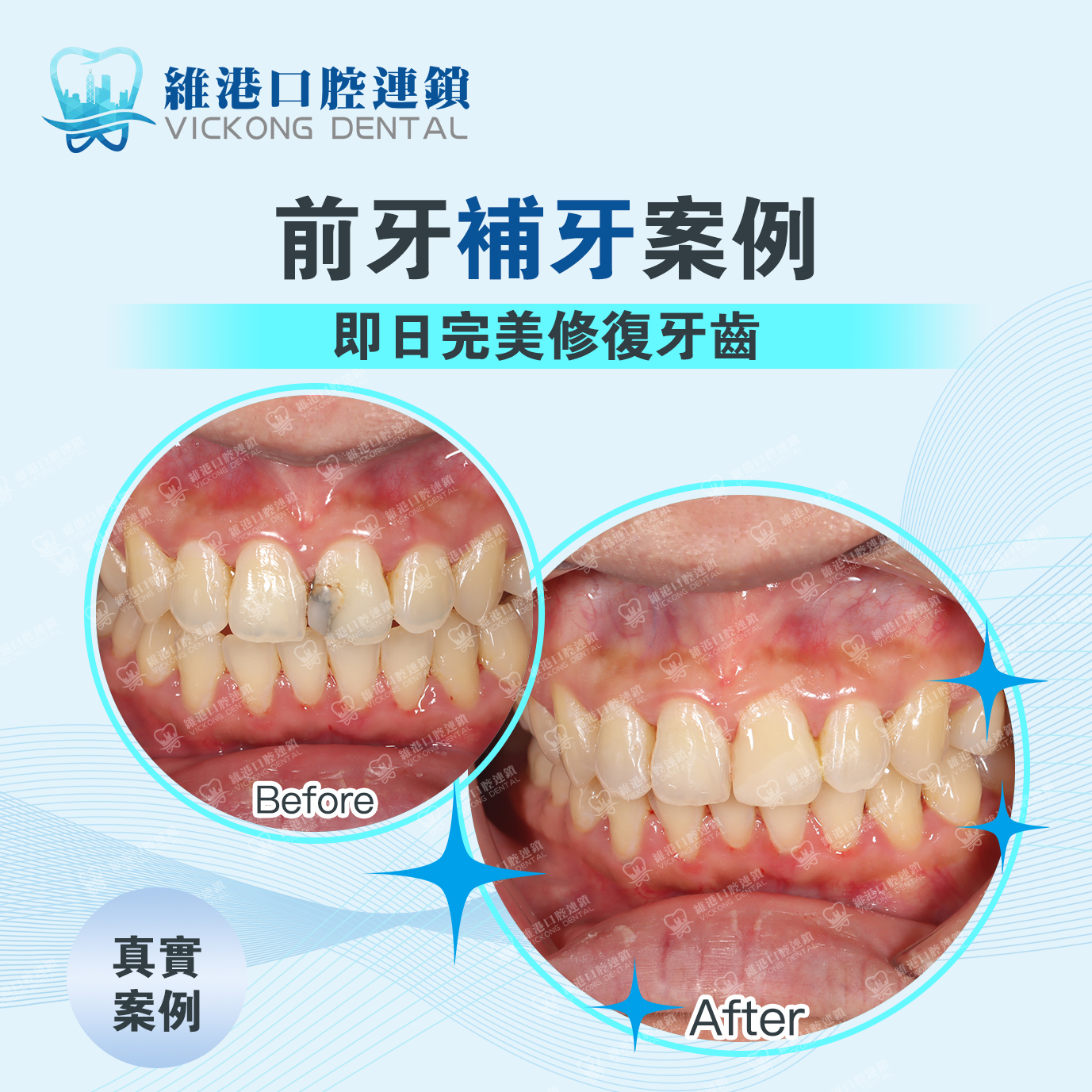 維港口腔補牙案例