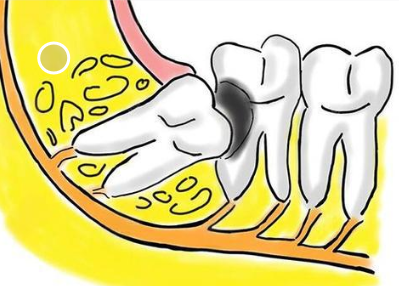 深圳拔智慧齒推薦