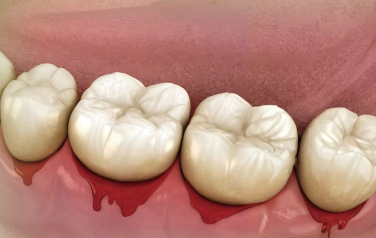 深圳牙周治療牙科排名