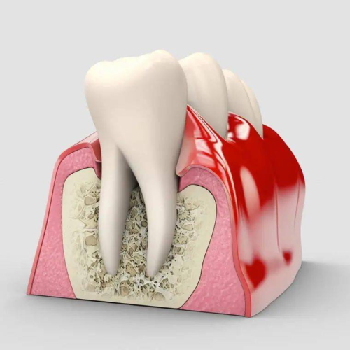 深圳牙周治療