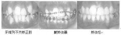 16歲香港中學生矯正案例