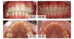 香港26歲莊小姐改善露齦笑及牙齒前突矯正案例