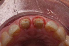 前牙全瓷牙修復案例