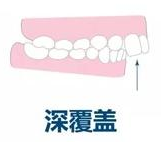 深覆盖-深圳箍牙-维港口腔连锁-维港欢笑口腔