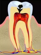 【深圳牙科】你知道牙髓炎還有不同的分類嗎？
