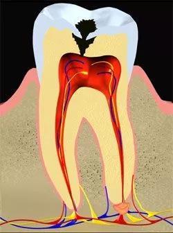 急性牙髓炎-牙痛-维港口腔连锁