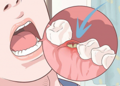 【深圳拔牙】拔完牙為什麼不要吐口水呢？吐口水會有什麼危害