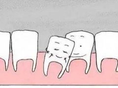【深圳牙科】牙齒鬆動一定要拔除嗎？