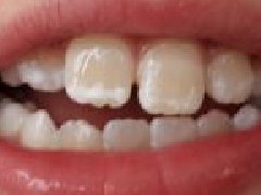 牙齒越來越白，去牙科檢查牙醫卻說牙齒不健康，這是因為什麼