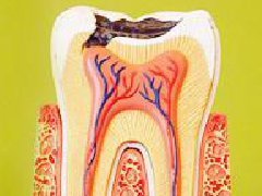 為什麼發炎的牙神經一定要去除乾淨呢？會很痛嗎？