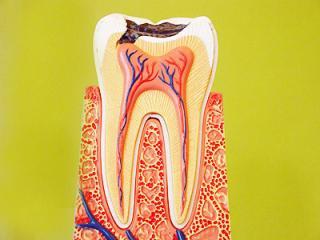 牙髓炎-牙痛-牙神经发炎-根管治疗-深圳杜牙根