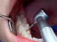 【深圳補牙】怎樣可以盡可能避免補牙材料脫落呢？