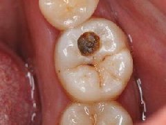 【深圳補牙】蛀牙沒有及時補牙會有什麼後果呢？