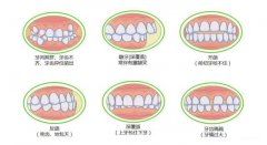 【深圳牙齒矯正】牙齒很小可以通過牙齒矯正改善嗎？